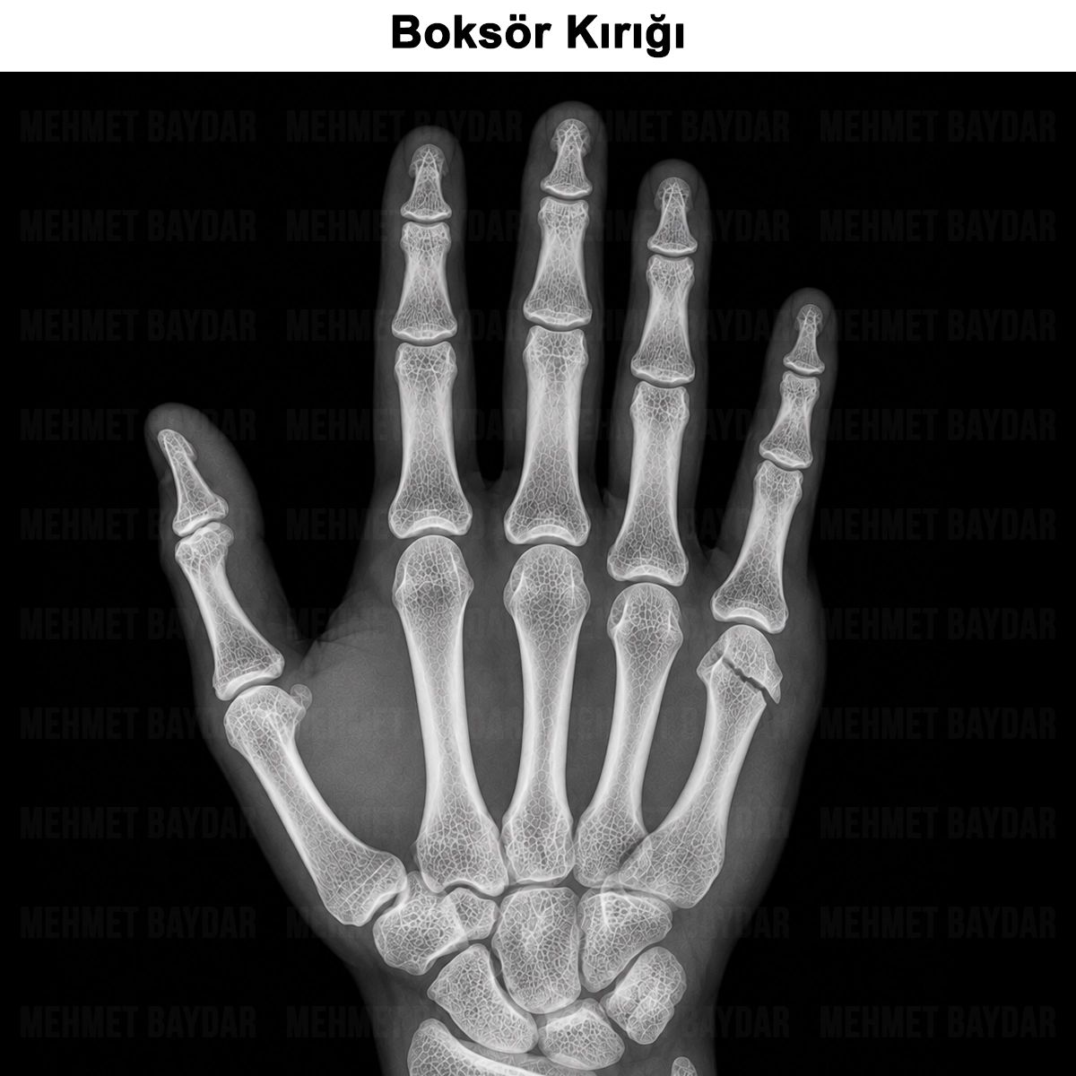 Boksör Kırığı: Nedir? Belirtileri, Tedavisi ve Ameliyatı