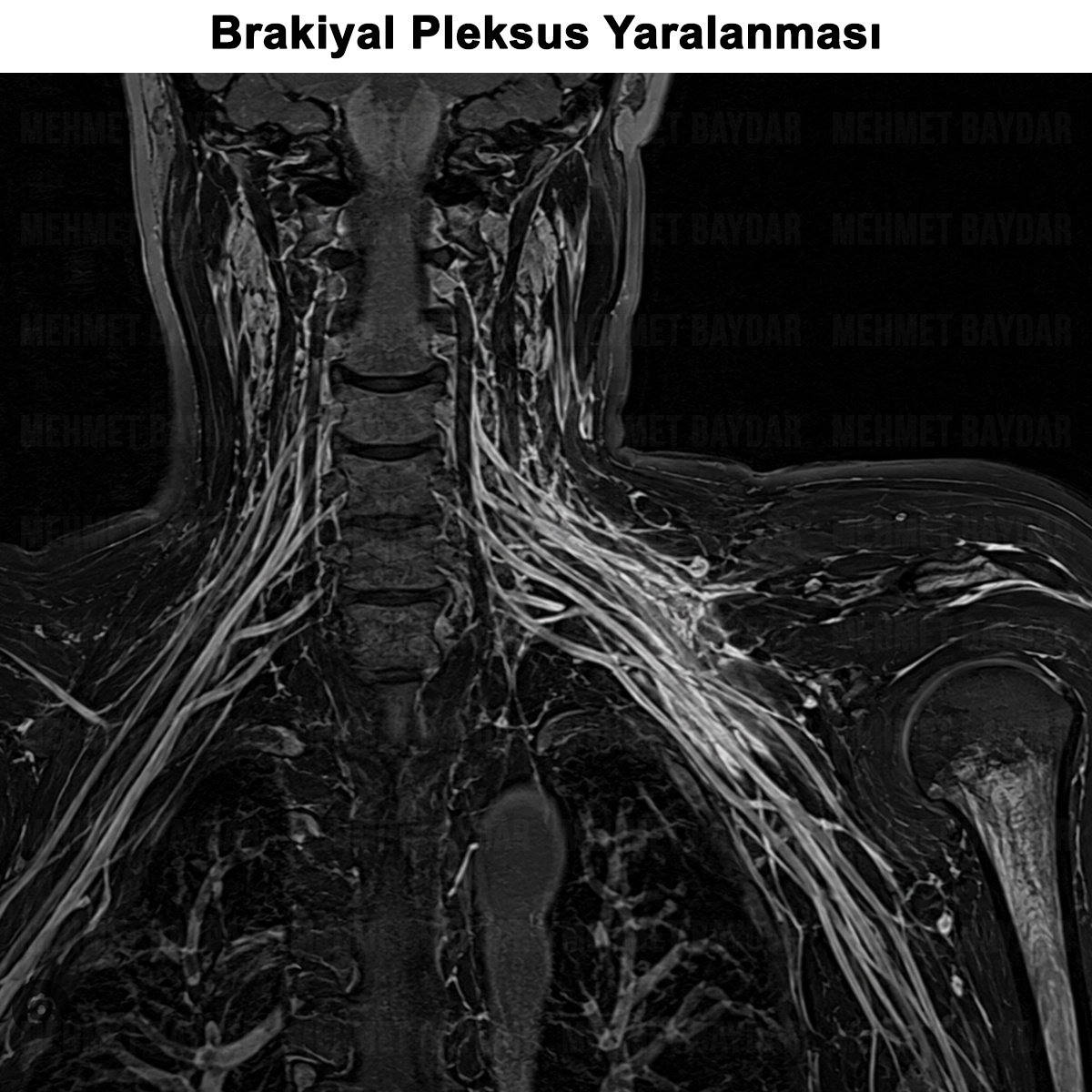 Brakiyal Pleksus Yaralanması