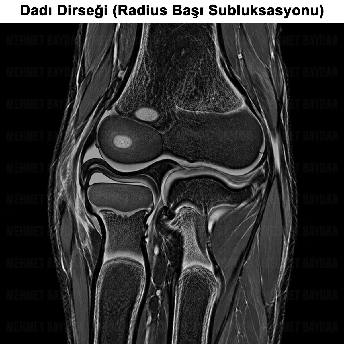 Dadı Dirseği (Radius Başı Subluksasyonu) Tanısı ve Tedavisi