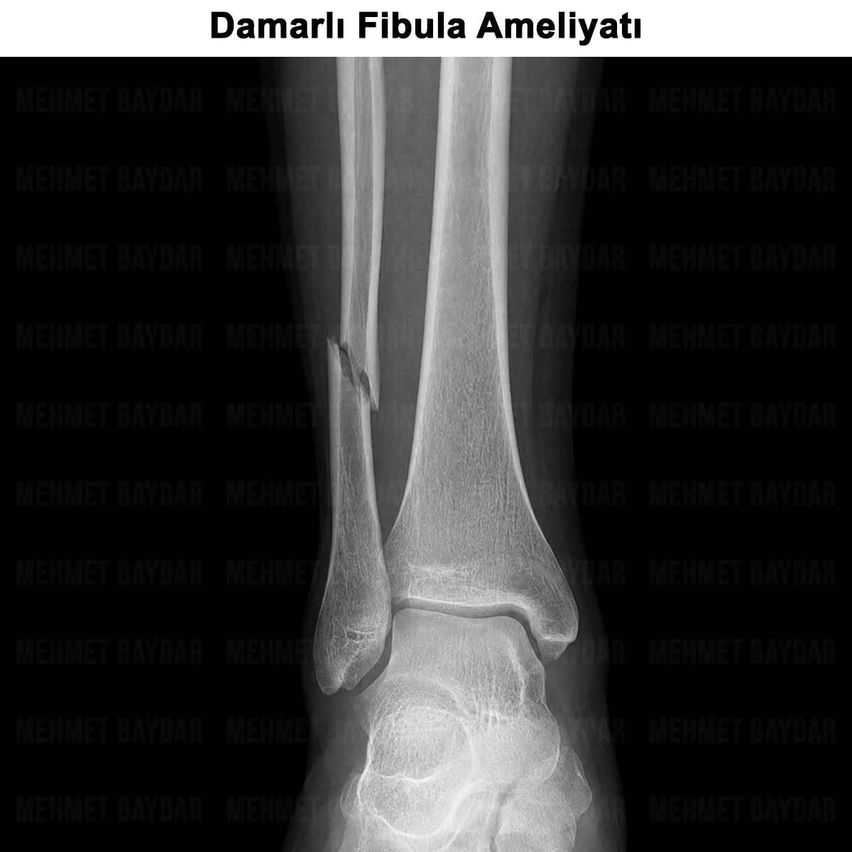 Damarlı Fibula Ameliyatı
