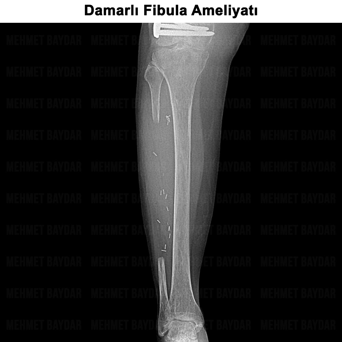 Damarlı Fibula Ameliyatı: Nedir? Kimlere ve Nasıl Yapılır?