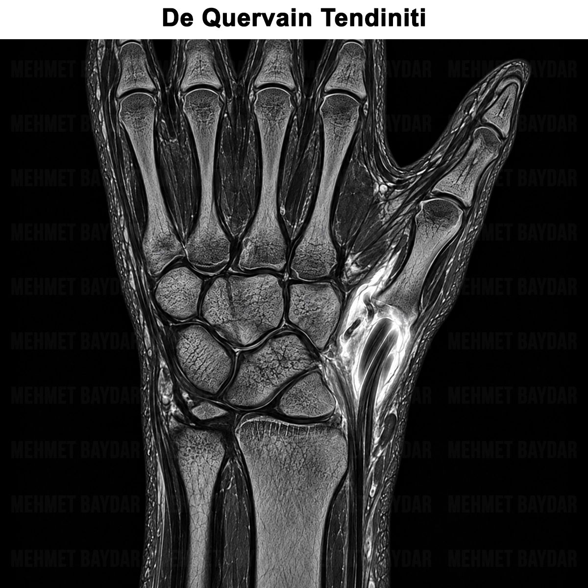 De Quervain Tendiniti: Belirtileri, Tedavisi ve Ameliyatı