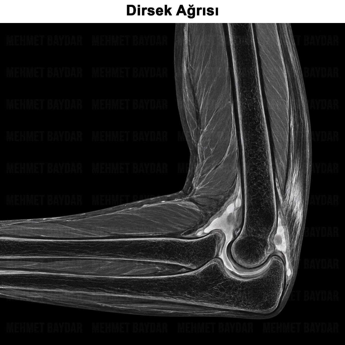 Dirsek Ağrısı Nedir? Nedenleri, Tanısı ve Tedavisi