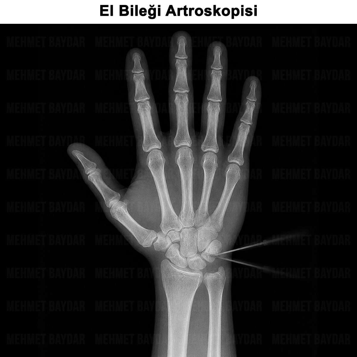 El Bileği Artroskopisi: Nedir? Avantajları ve Riskleri