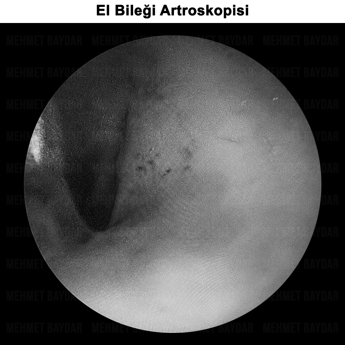 El Bileği Artroskopisi: Nedir? Avantajları ve Riskleri