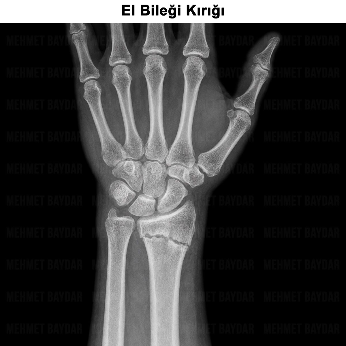 El Bileği Kırığı: Belirtileri, Tanısı, Tedavisi ve Ameliyatı