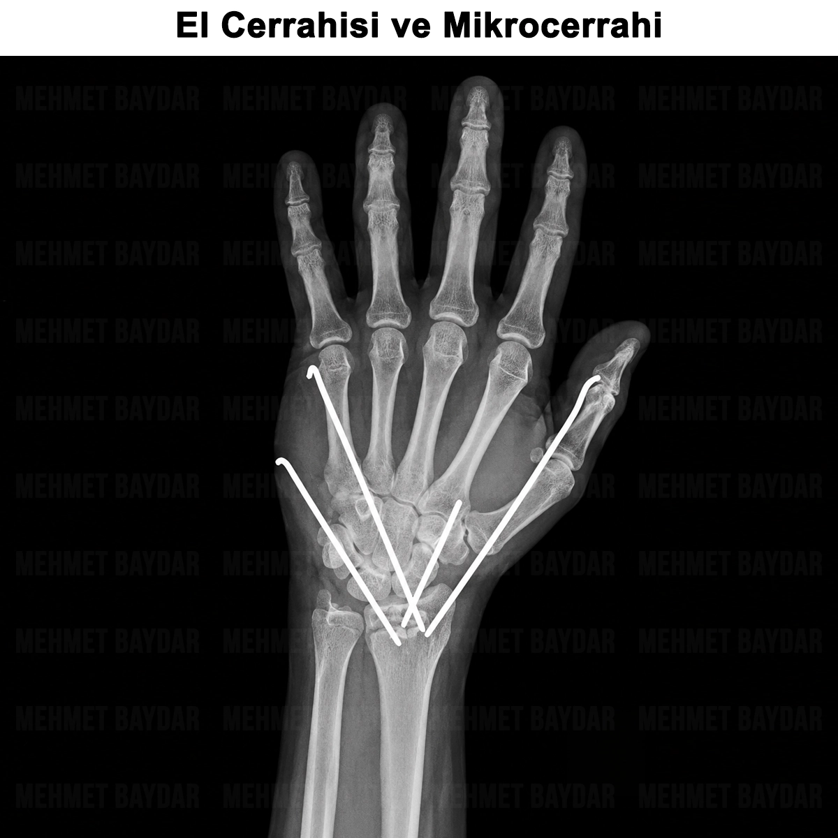 El Cerrahisi ve Mikrocerrahi: Nedir? İlgi Alanları?