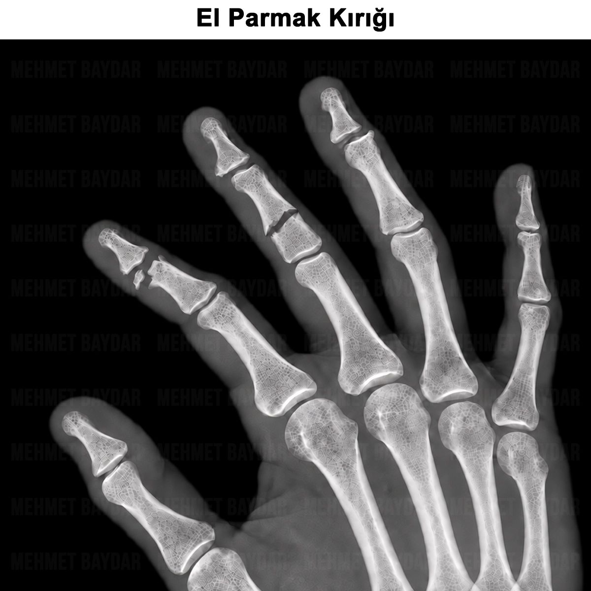 El Parmak Kırığı: Nedir? Belirtileri, Tedavisi, Ameliyatı