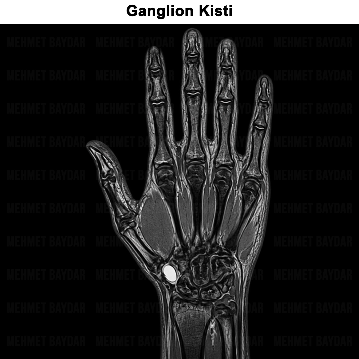 Ganglion Kisti Nedir? Nedenleri? Kimlerde Görülür? Tedavisi