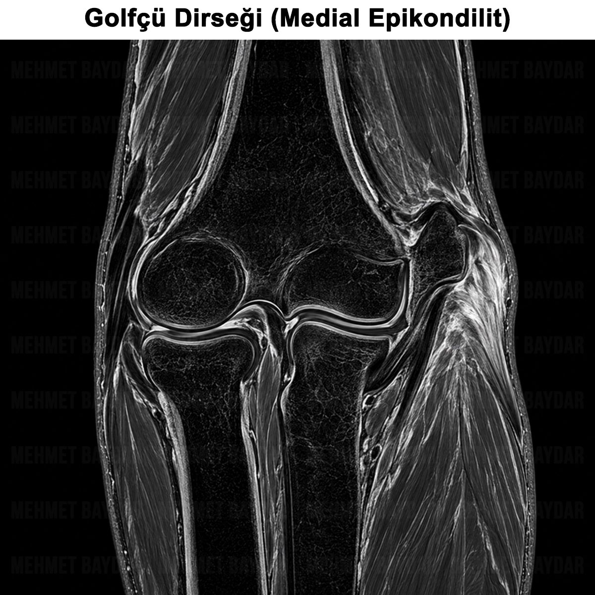 Golfçü Dirseği (Medial Epikondilit) Belirtileri ve Tedavisi