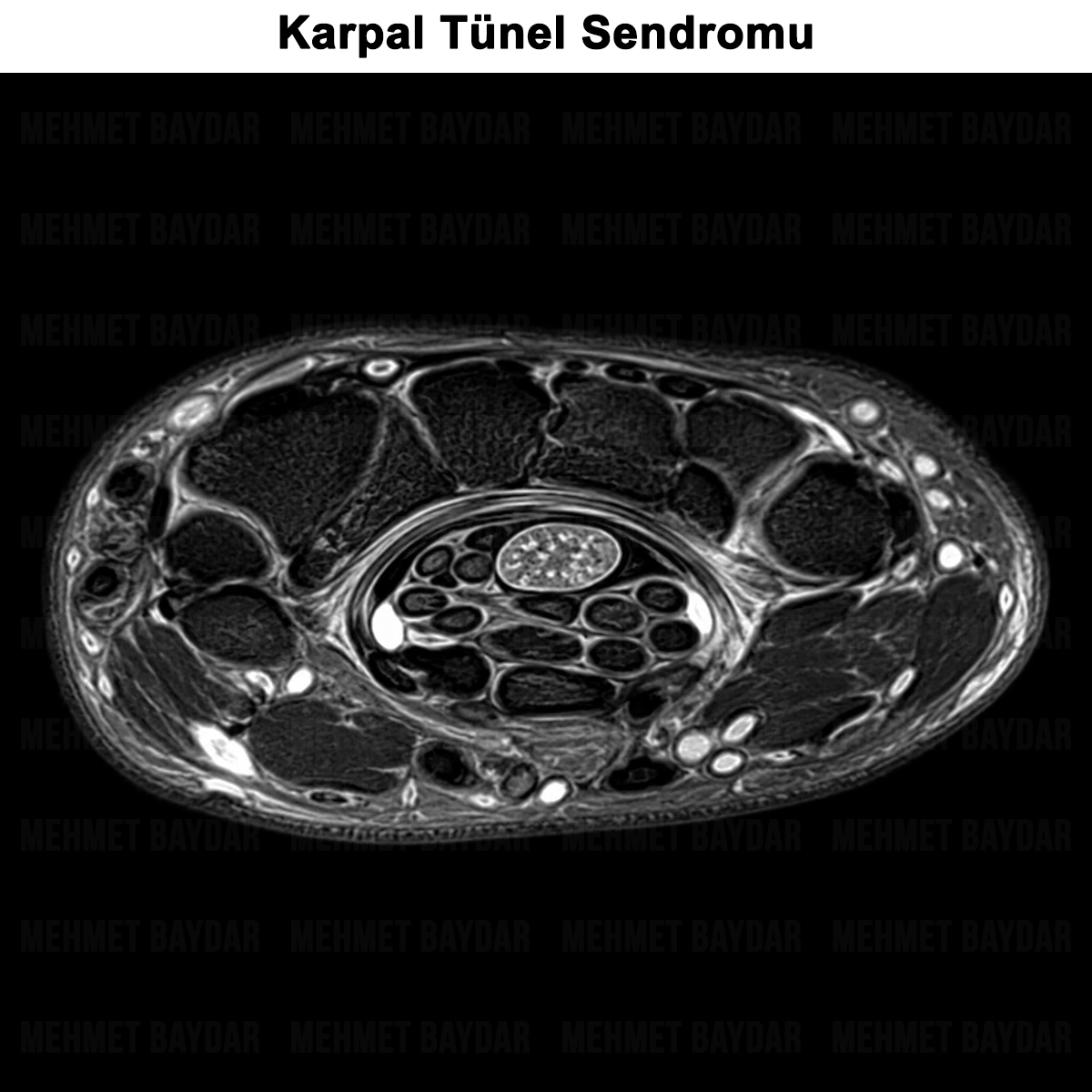 Karpal Tünel Sendromu: Nedir? Belirtileri ve Tedavisi