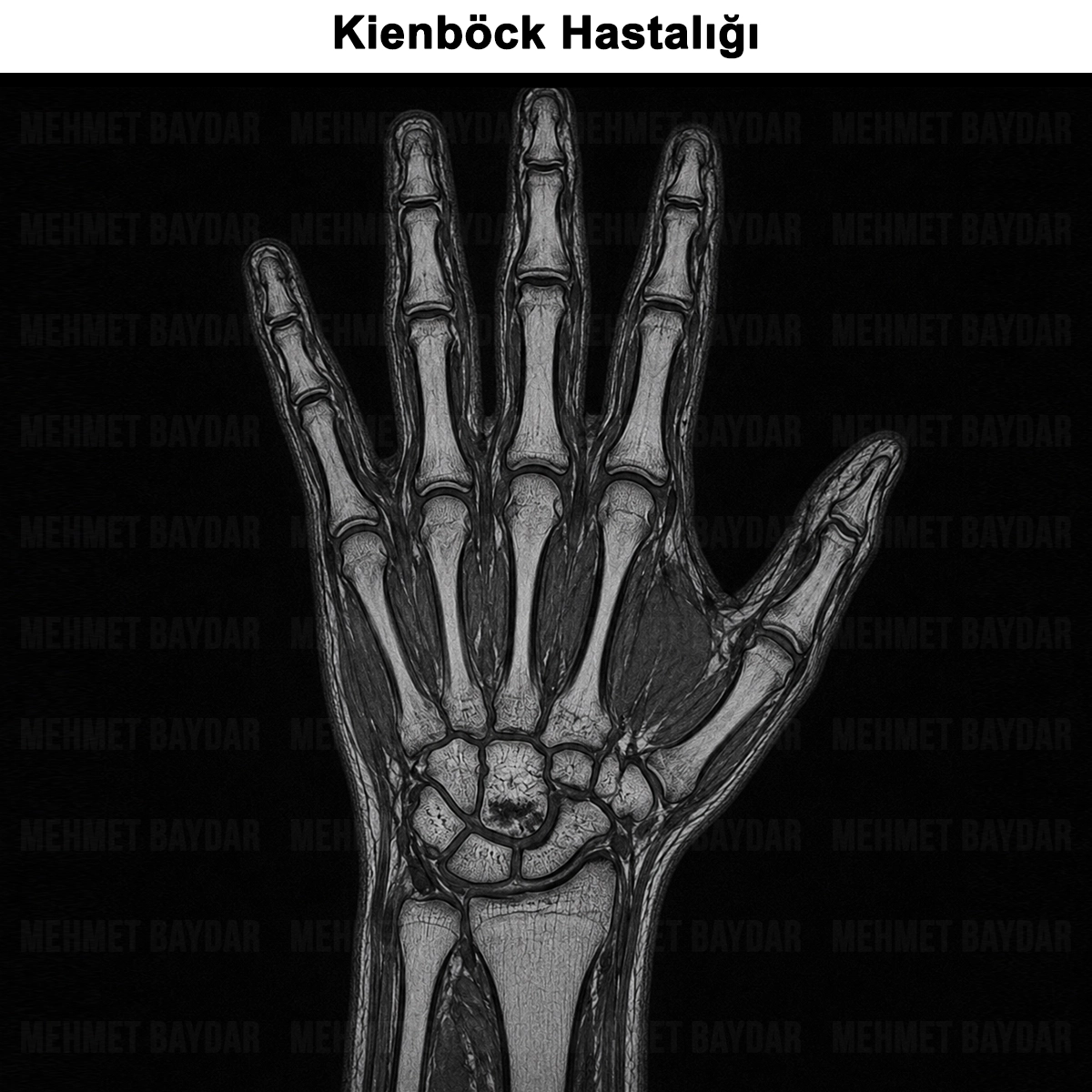 Kienböck Hastalığı: Nedir? Belirtileri, Evreleri, Tedavisi