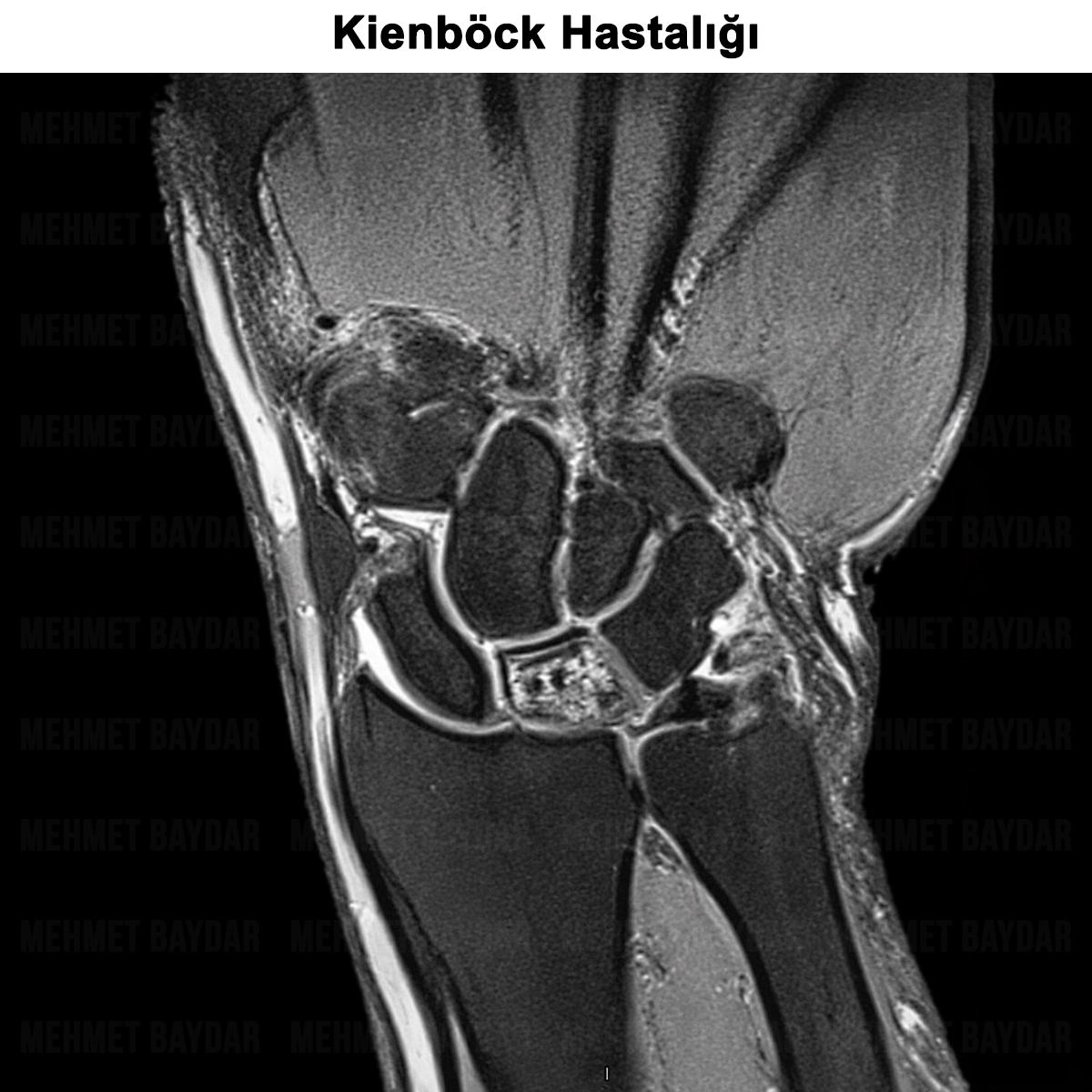 Kienböck Hastalığı: Nedir? Belirtileri, Evreleri, Tedavisi