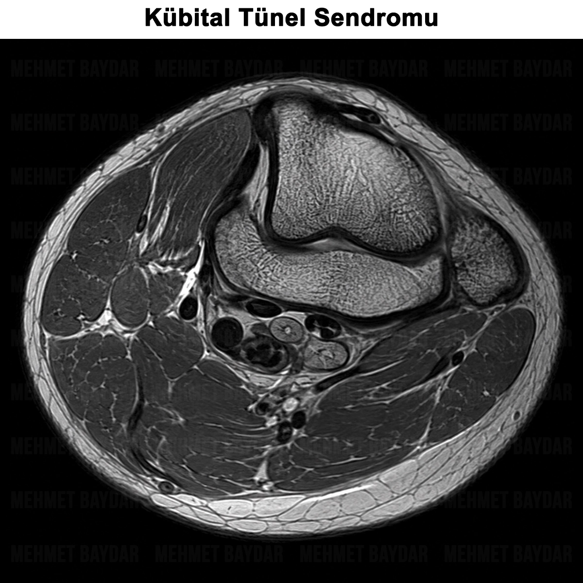 Kübital Tünel Sendromu