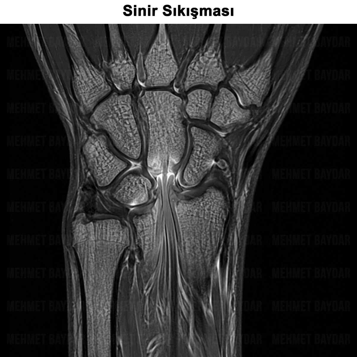 Sinir Sıkışması