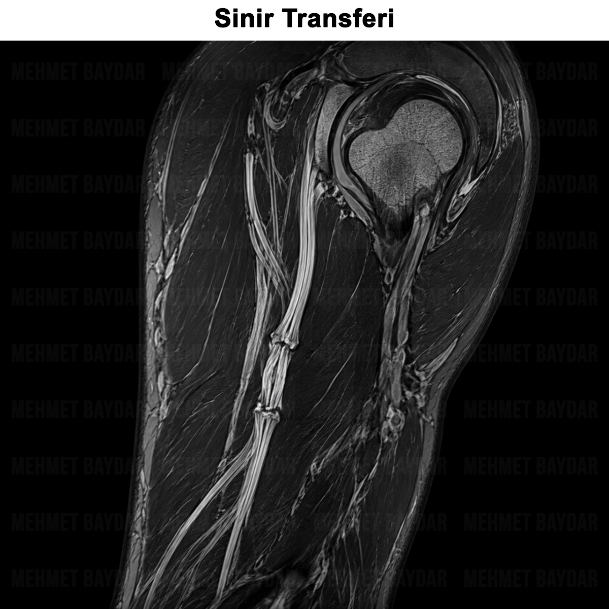 Sinir Transferi