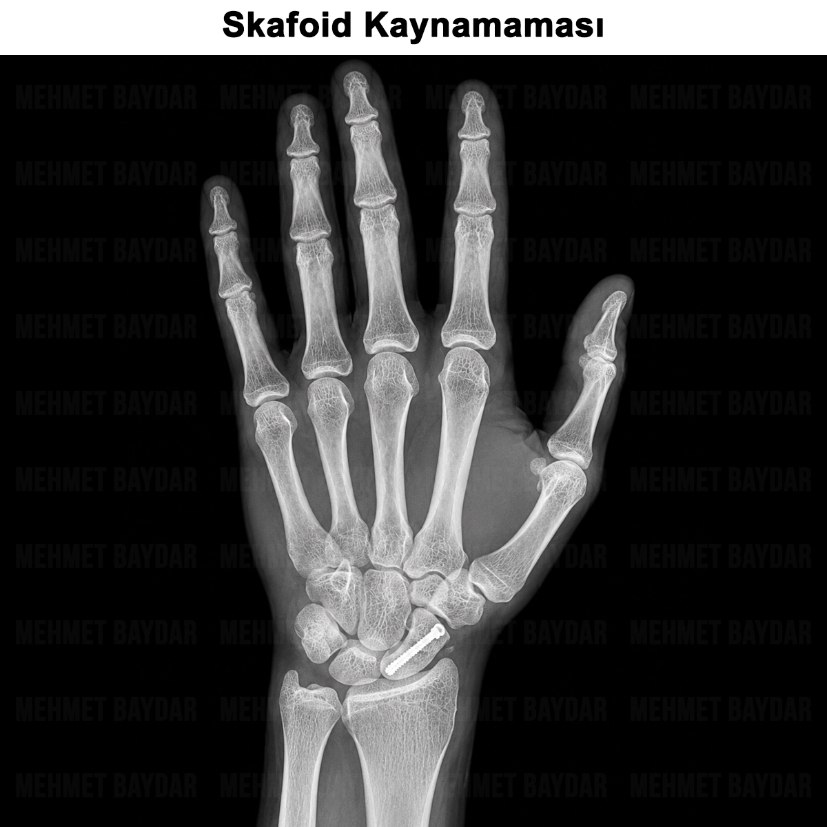 Skafoid Kaynamaması (Psödoartroz): Nedir? Tanısı ve Tedavisi