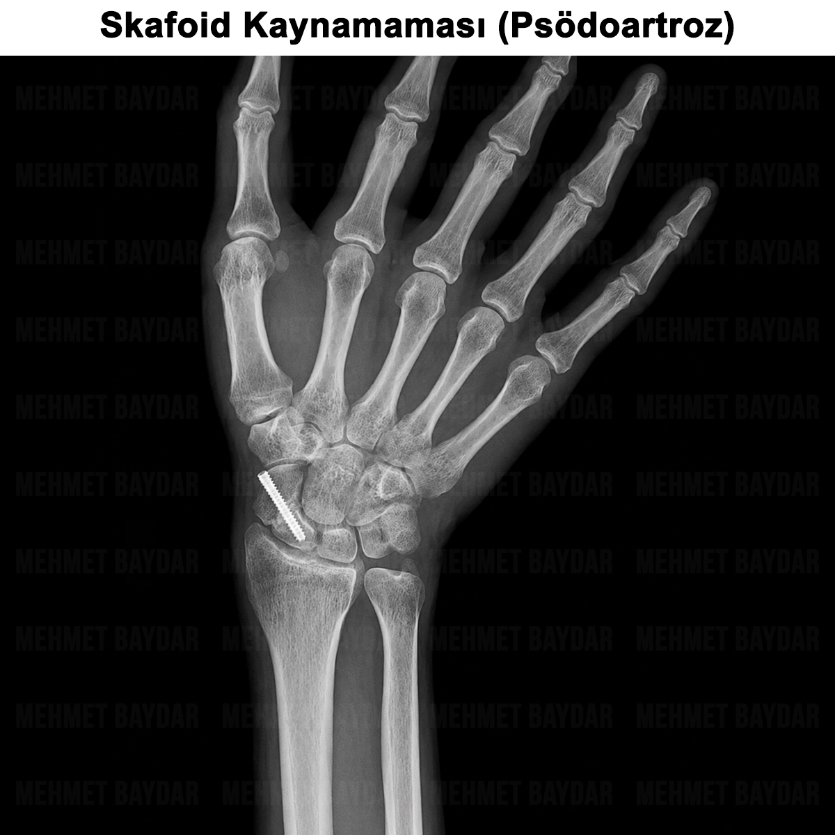 Skafoid Kaynamaması (Psödoartroz): Nedir? Tanısı ve Tedavisi
