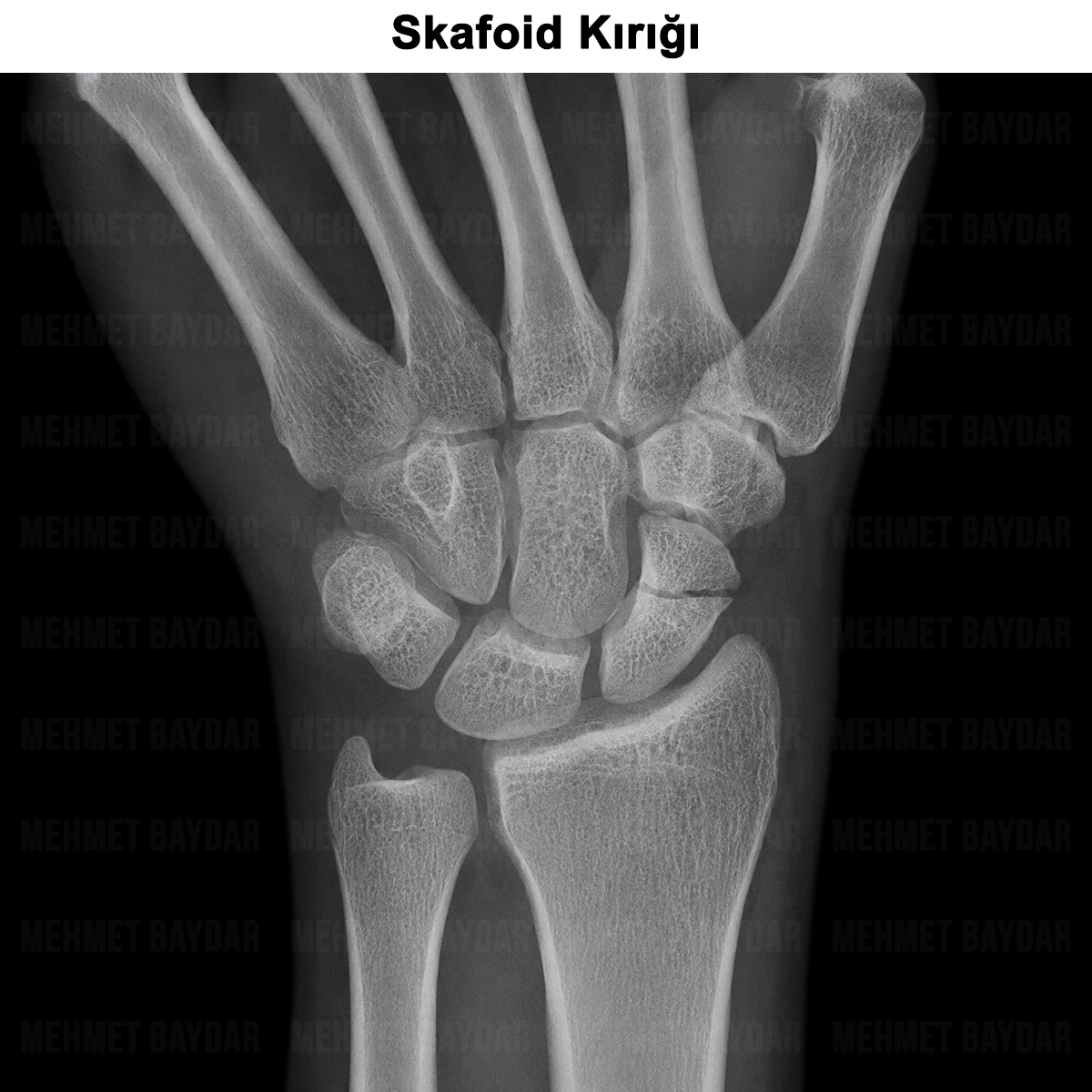 Skafoid Kırığı: Nedir? Tedavisi ve Ameliyatı