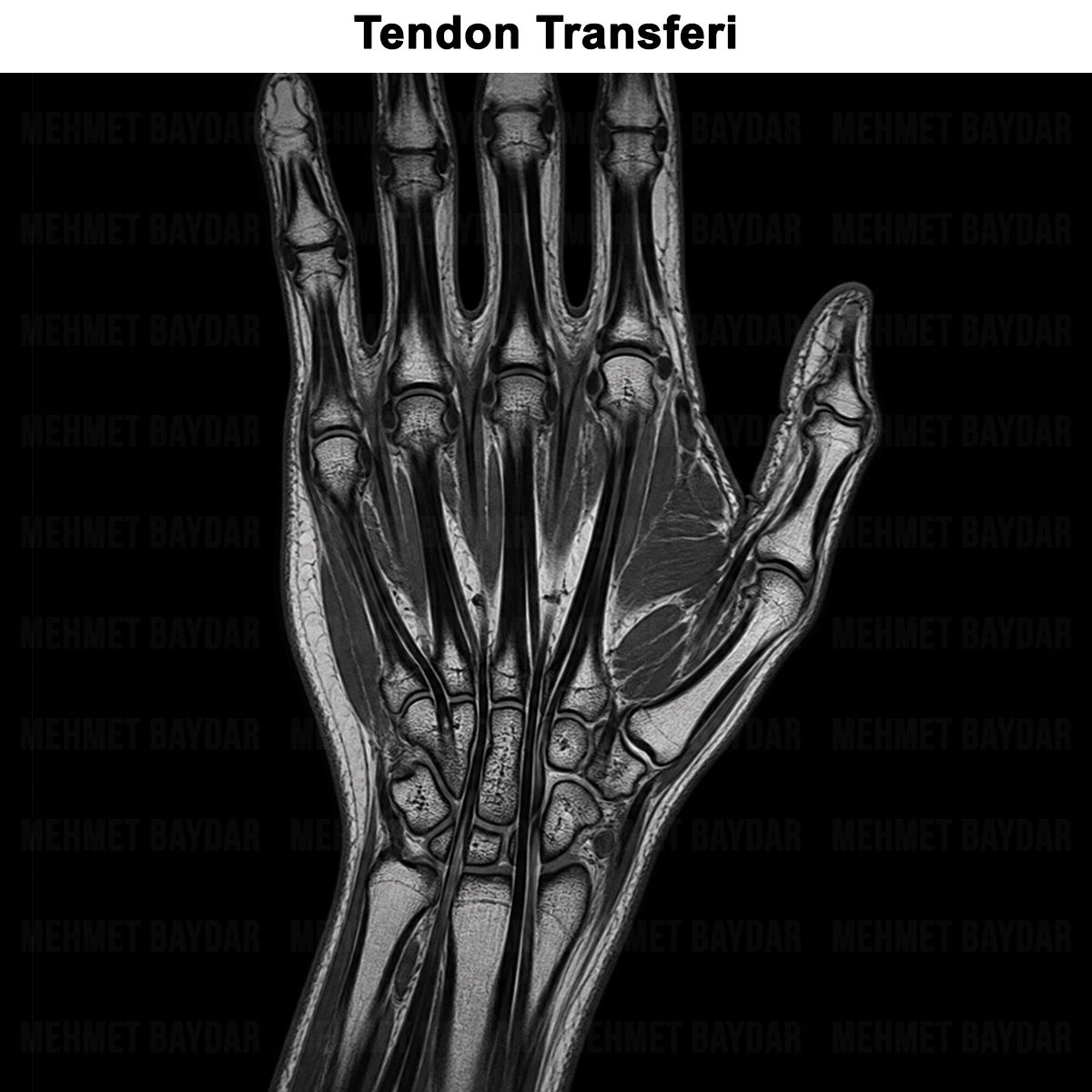 Tendon Transferi Ameliyatı: Ne Zaman ve Neden Yapılır?