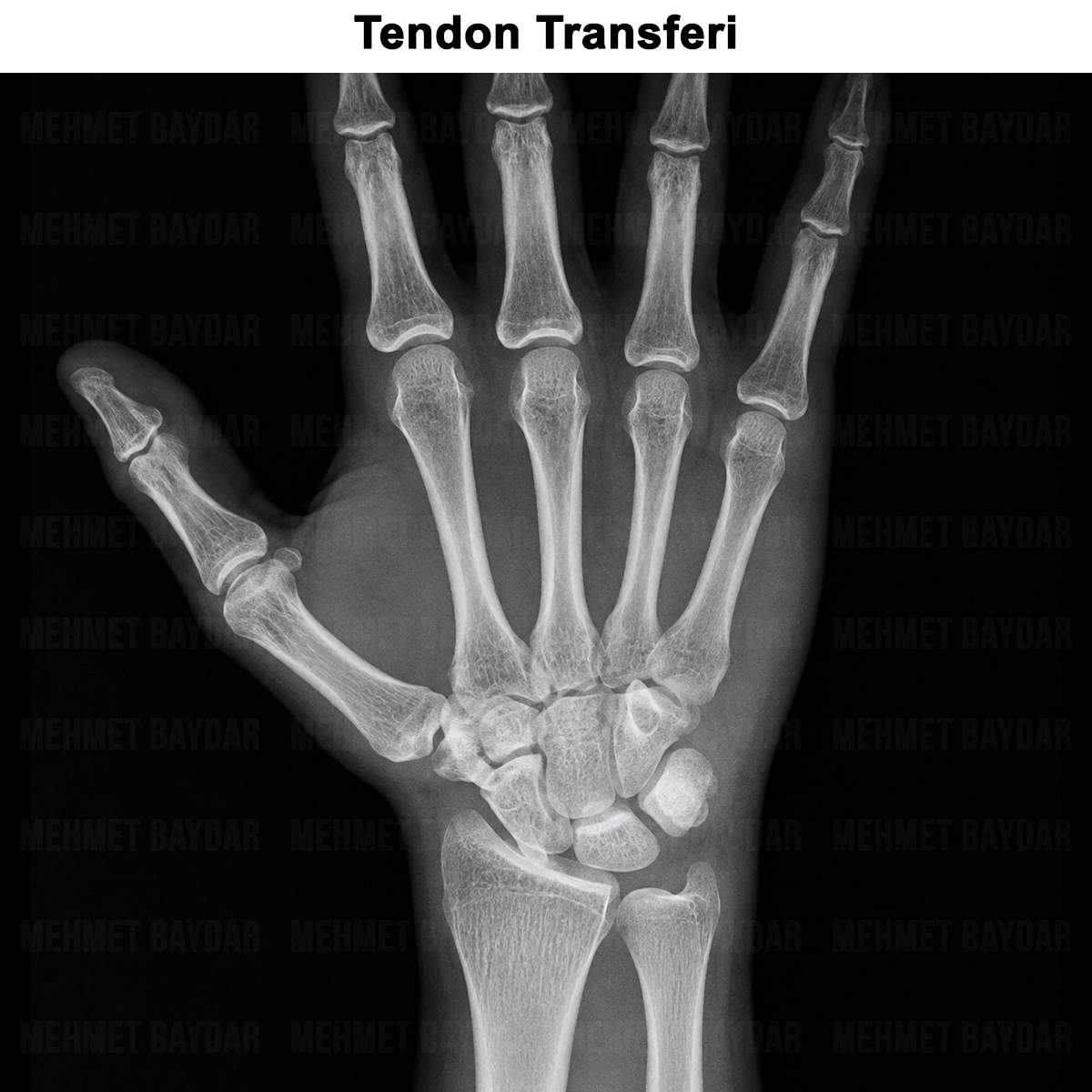 Tendon Transferi Ameliyatı