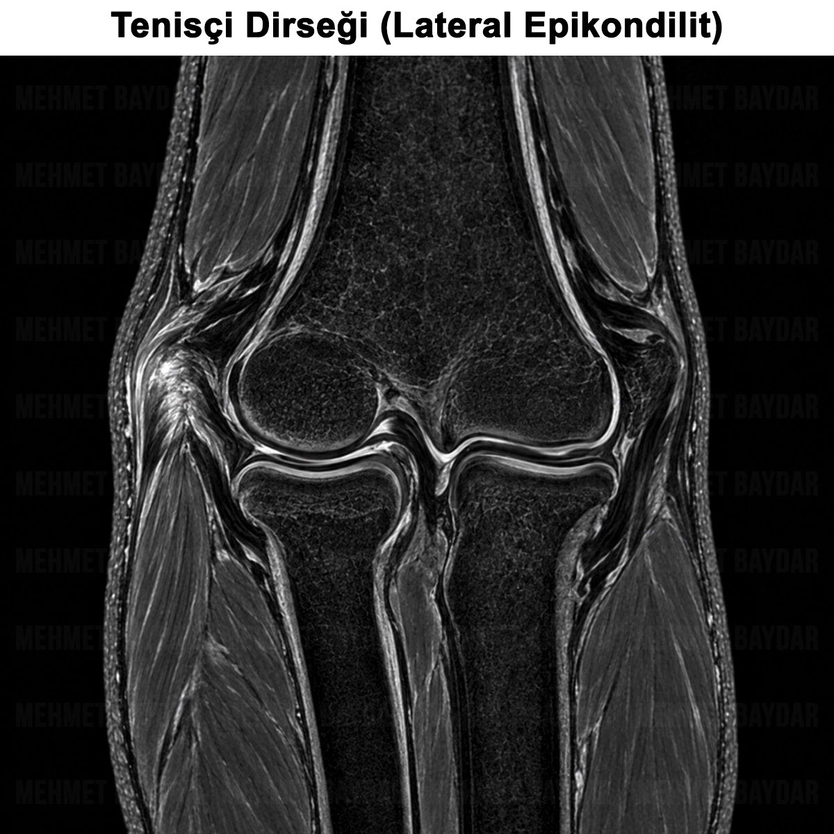 Tenisçi Dirseği (Lateral Epikondilit) Tanısı ve Tedavisi
