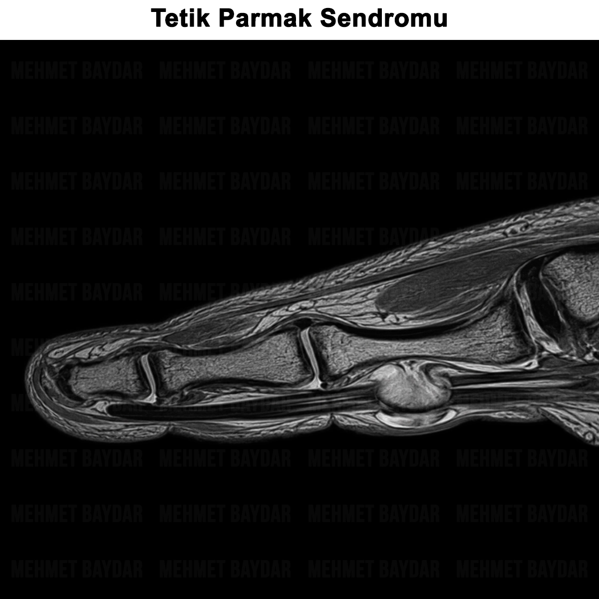 Tetik Parmak Sendromu: Nedir? Tanısı ve Ameliyatı