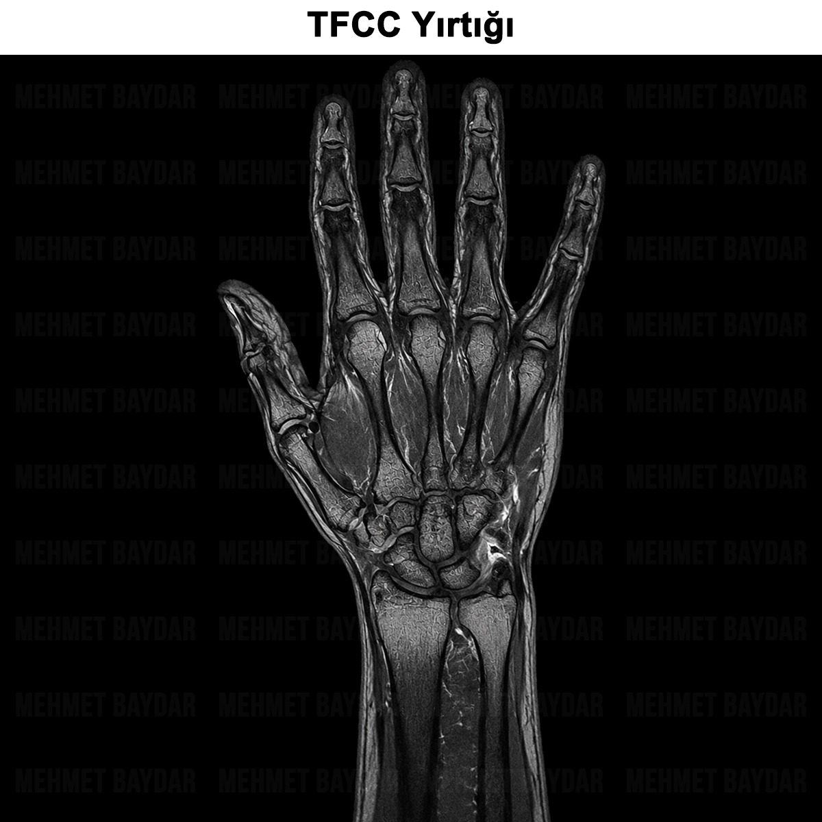 TFCC Yırtığı: Nedir? Tanısı, Tedavisi ve Ameliyatı