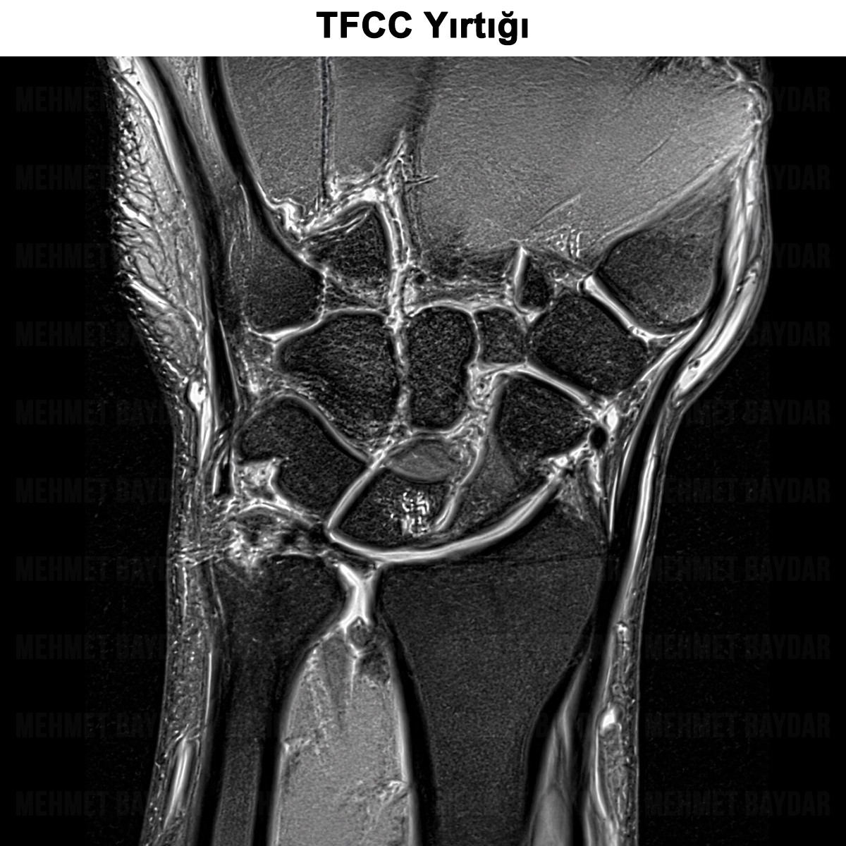 TFCC Yırtığı: Nedir? Tanısı, Tedavisi ve Ameliyatı